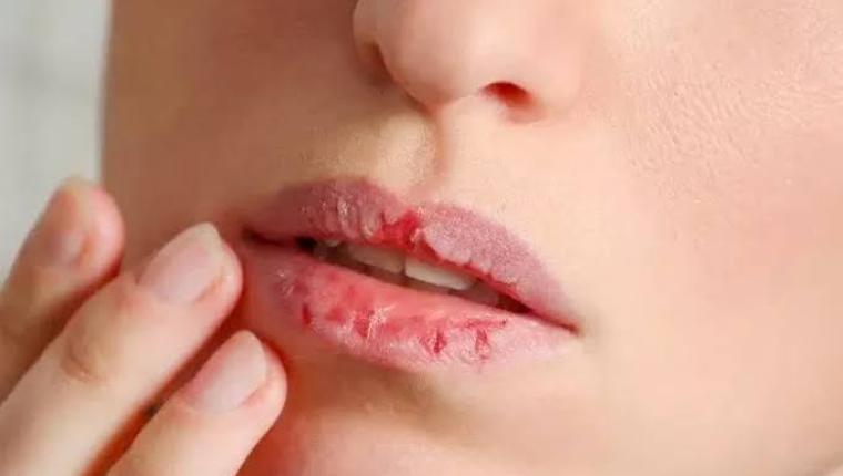 Cara Menjaga Kesehatan Bibir yang Kering dan Mengelupas, Yuk Simak!