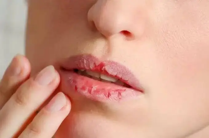 Cara Menjaga Kesehatan Bibir yang Kering dan Mengelupas, Yuk Simak!