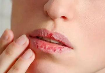 Cara Menjaga Kesehatan Bibir yang Kering dan Mengelupas, Yuk Simak!