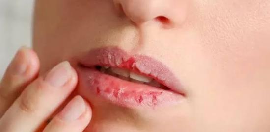 Cara Menjaga Kesehatan Bibir yang Kering dan Mengelupas, Yuk Simak!
